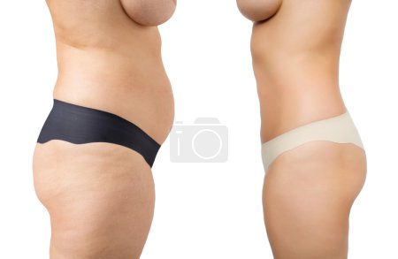 Back Contouring In Weight Loss Patients